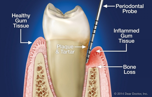 깊어진 치주낭은 잇몸염증과 치조골(치아주변 뼈)을 녹인다