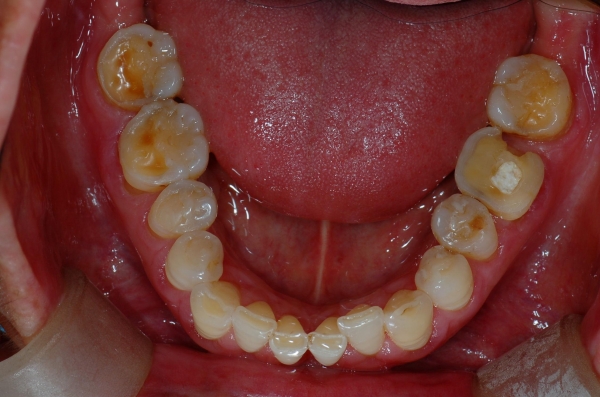 70대 어느 여성의 닳아지고 깨진 치아사진, 다행히 충치나 잇몸병은 없다.